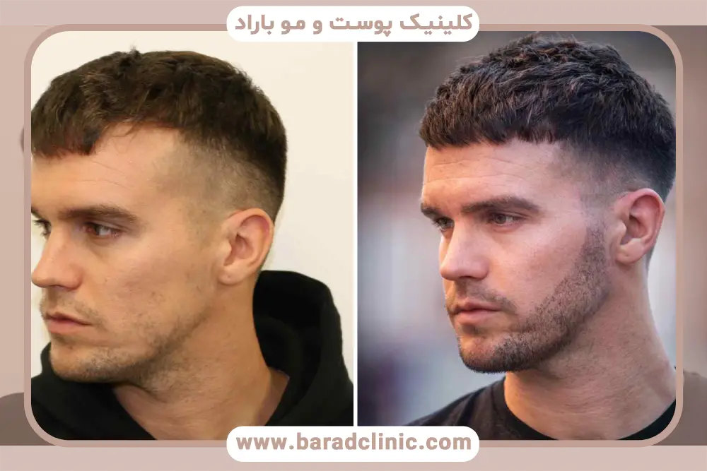 کاشت ریش عکس