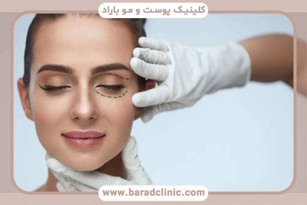 بلفاروپلاستی با لیزر