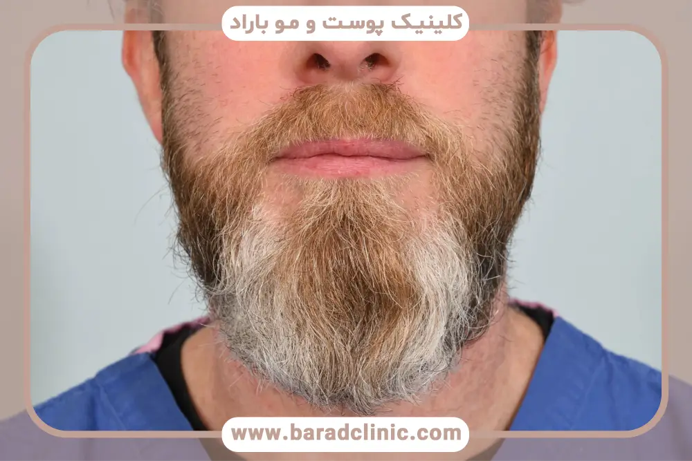 شرایط کاشت ریش