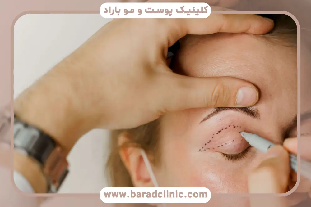 بلفاروپلاستی تهران