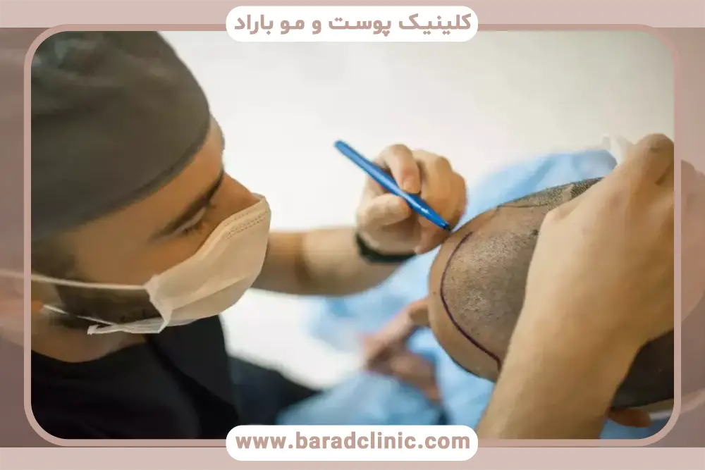 مشاوره کاشت مو تهران