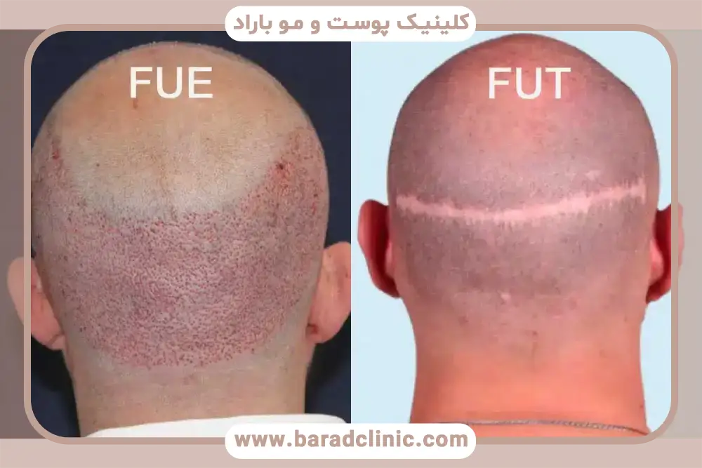 هزینه کاشت مو fut
