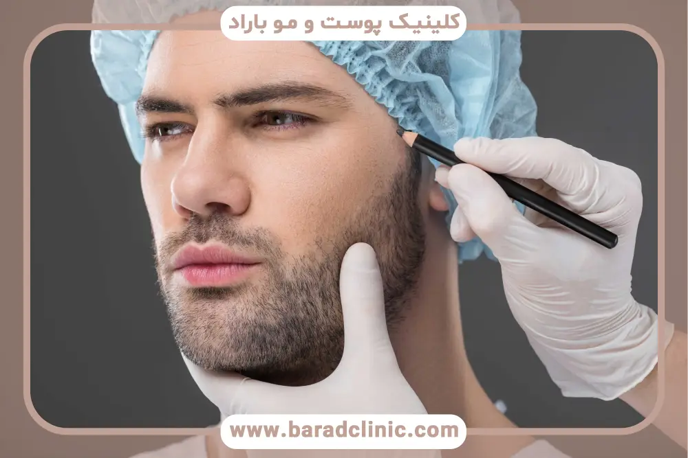 کاشت ریش به روش میکروگرافت