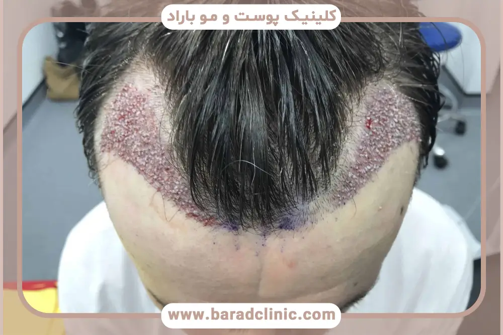 ایا برای کاشت مو باید کچل کرد