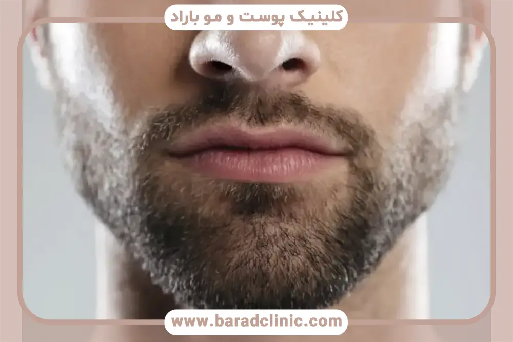 کاشت ریش به روش sut