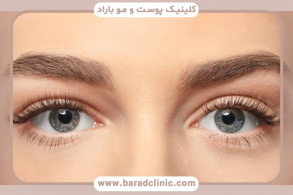 بلفاروپلاستی جراحی پلک گربه ای