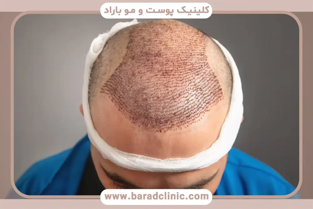 کاشت مو به روش fit