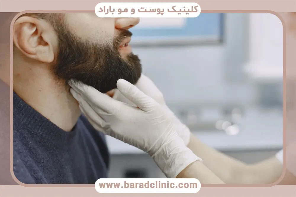 هزینه کاشت ریش تهران