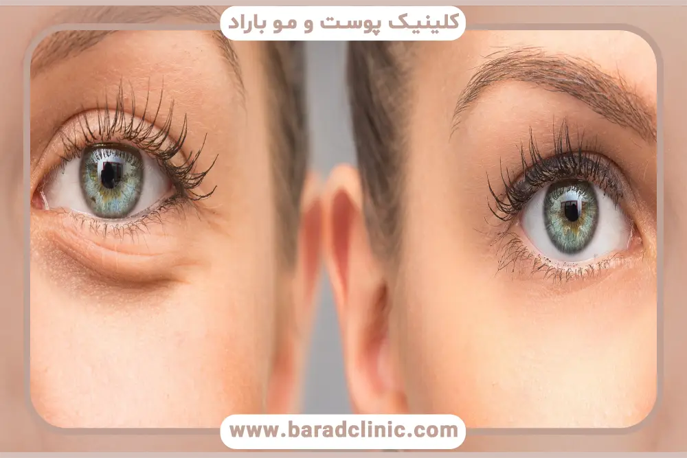 بلفاروپلاستی گودی زیر چشم