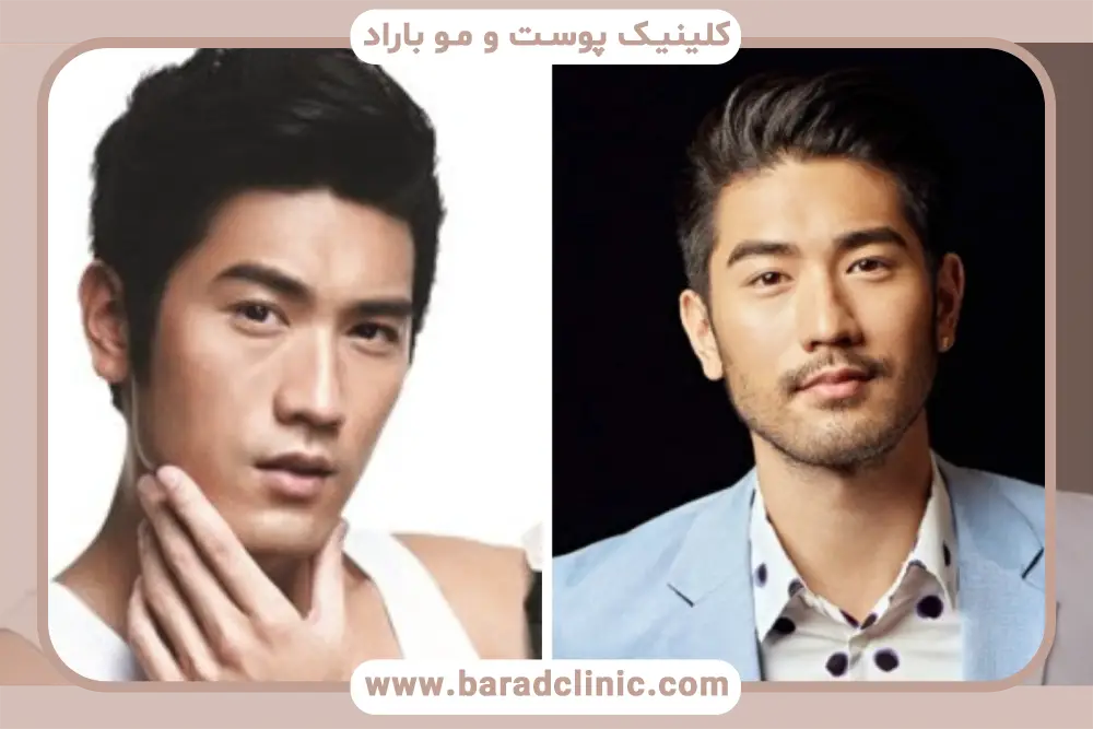 فواید کاشت ریش