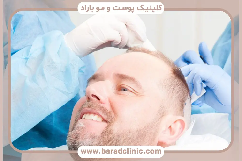 نتیجه کاشت مو بعد از سه ماه