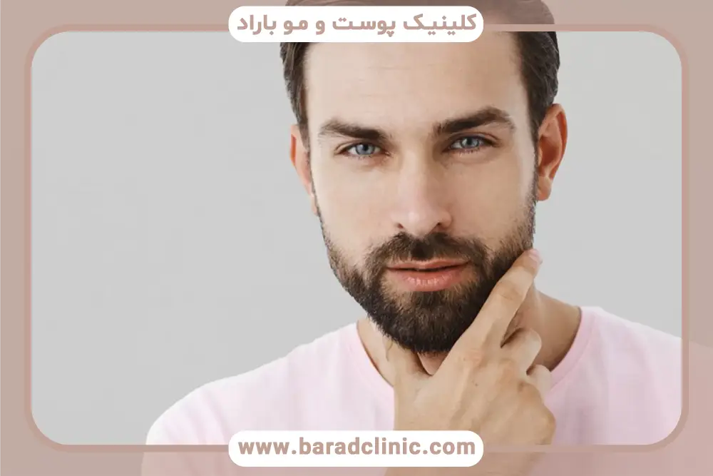 کاشت ریش به روش fue
