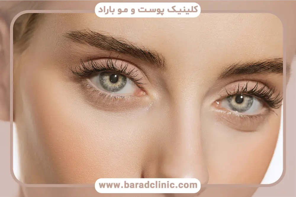 بلفاروپلاستی یا لیفت شقیقه