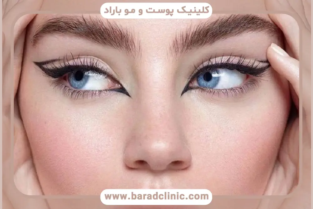 بلفاروپلاستی چشم شرقی