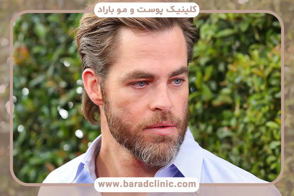 کاشت ریش طبیعی