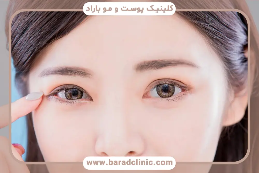 بلفاروپلاستی چشم آسیایی