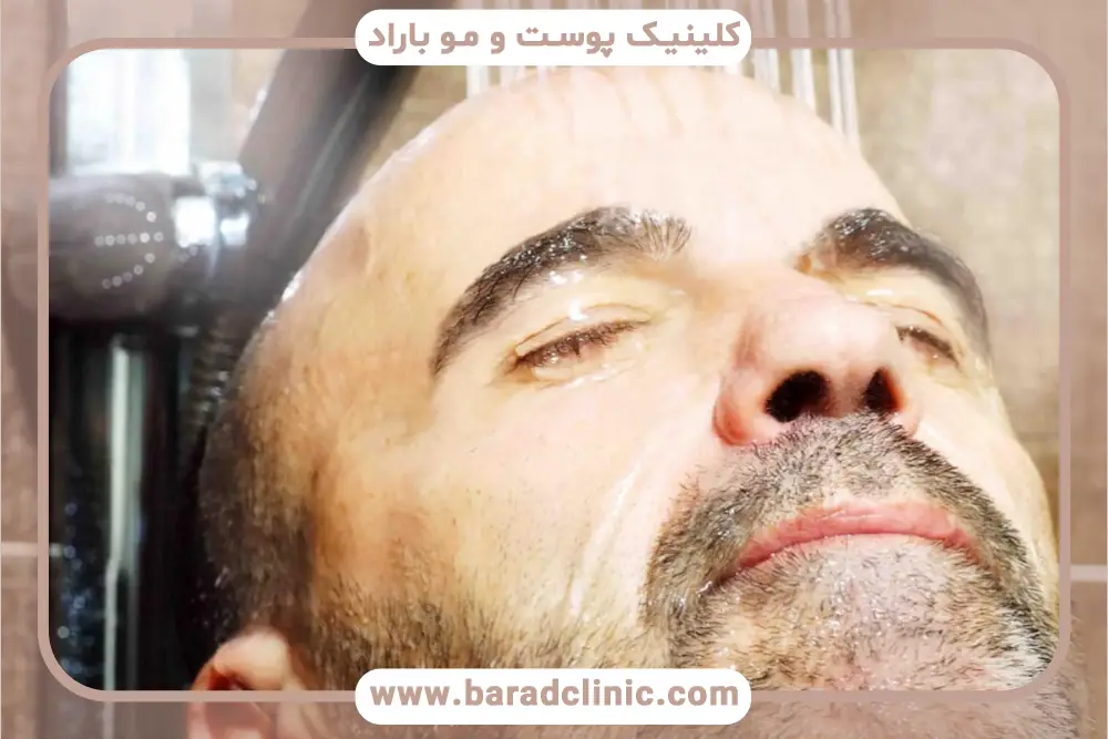 حمام بعد از کاشت ریش