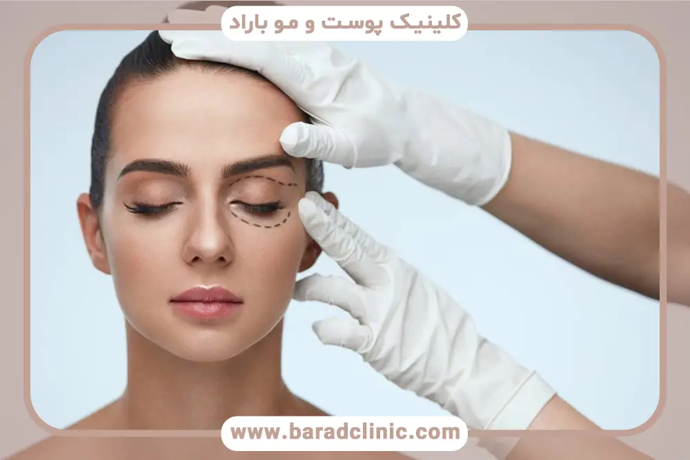 جراح بلفاروپلاستی