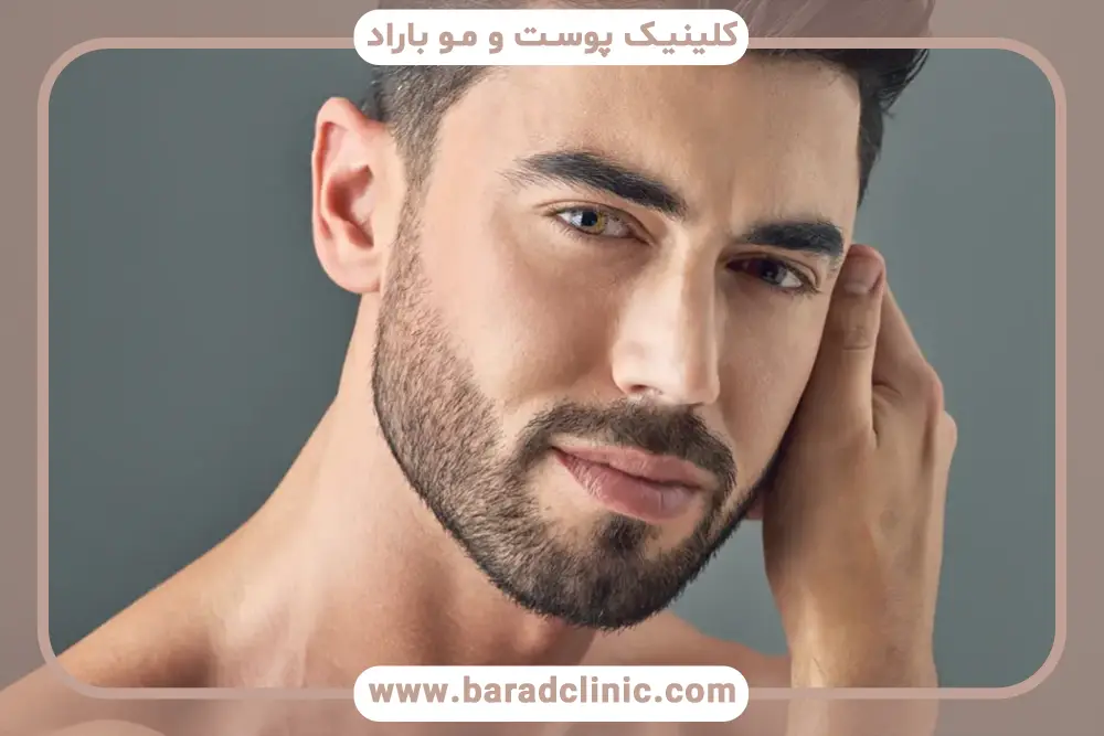 کاشت ریش روی چانه