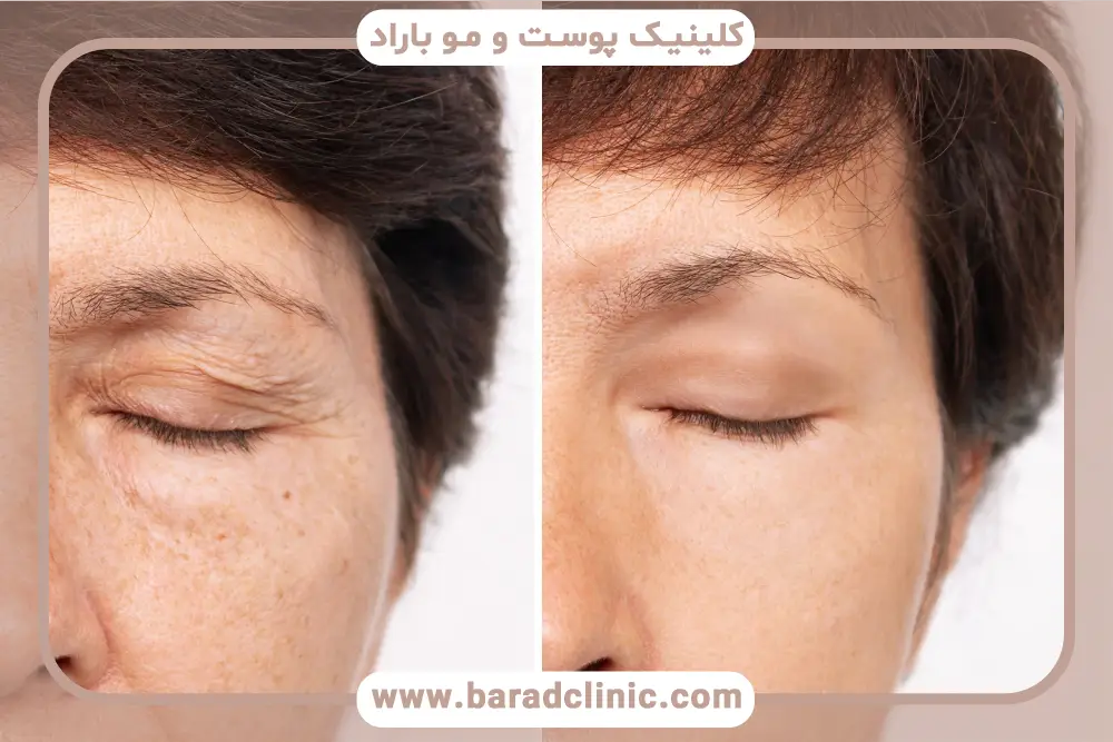 چند روز بعد از عمل بلفاروپلاستی بخیه کشیده می شود