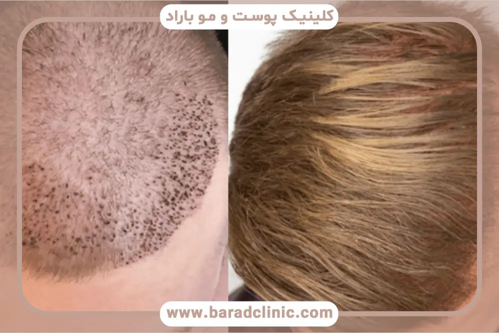 عکس کاشت مو بعد از سه ماه