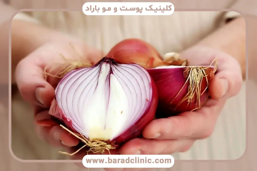 خوردن پیاز بعد از کاشت مو