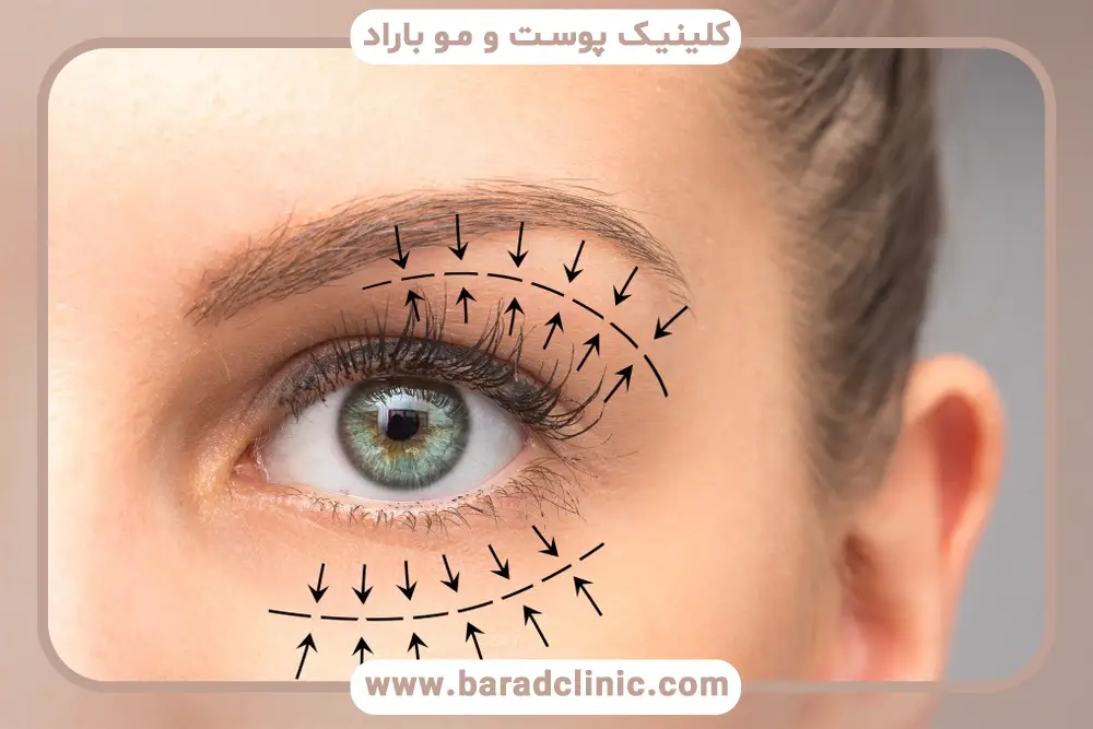 ورزش بعد از بلفاروپلاستی