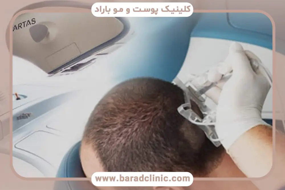 دستگاه کاشت مو