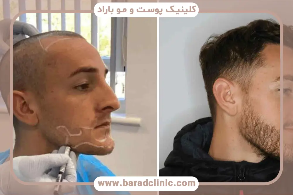 هزینه کاشت خط ریش