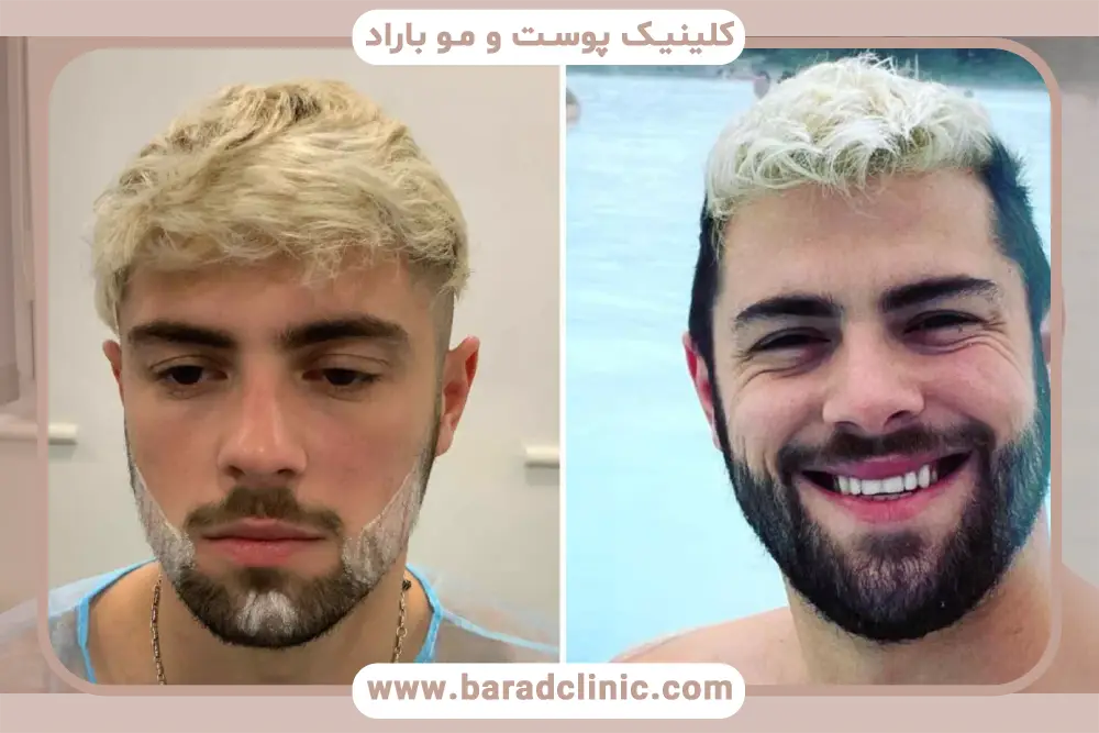 قیمت کاشت ریش و سبیل در تهران