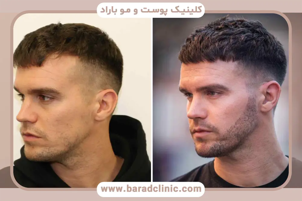 فیلم کاشت ریش