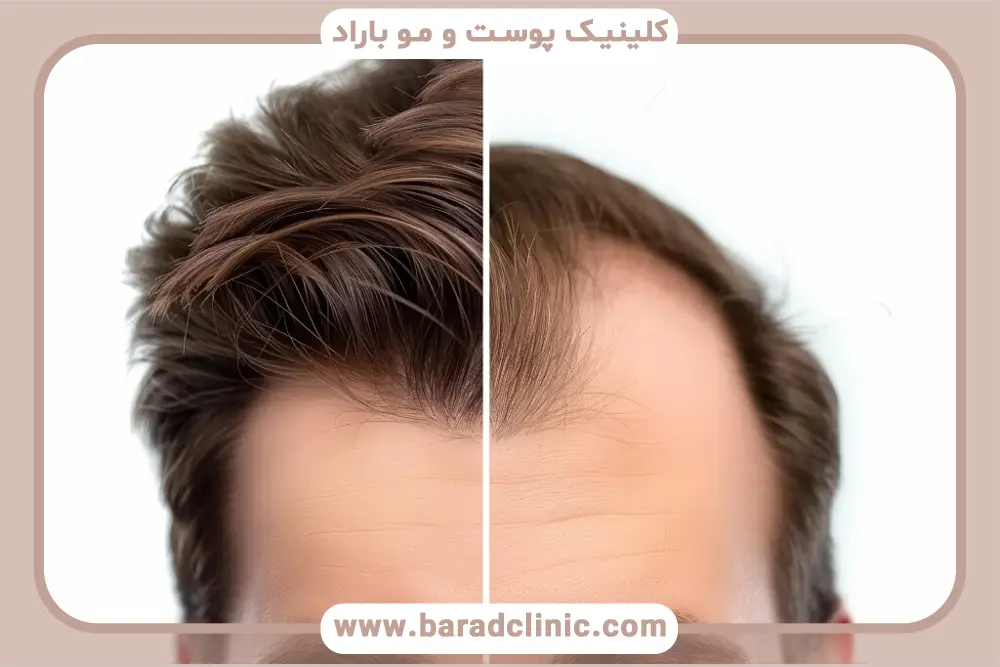 FUE بهترین روش کاشت مو با تراکم بالا 