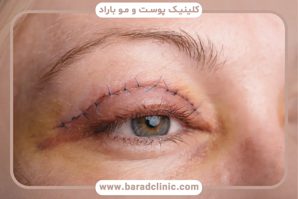 دلایل خونریزی بعد از بلفاروپلاستی