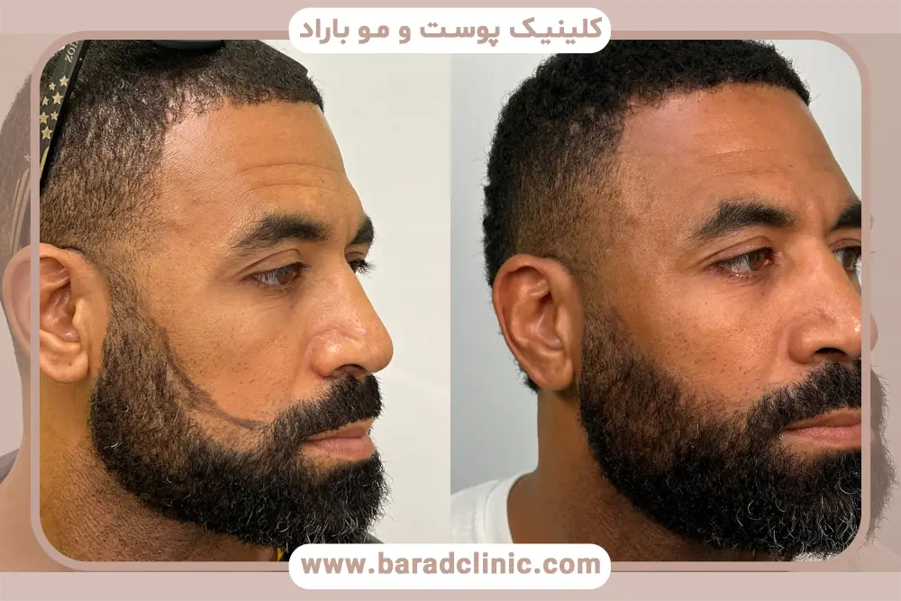 پشت سر، بهترین بانک مو در کاشت ریش