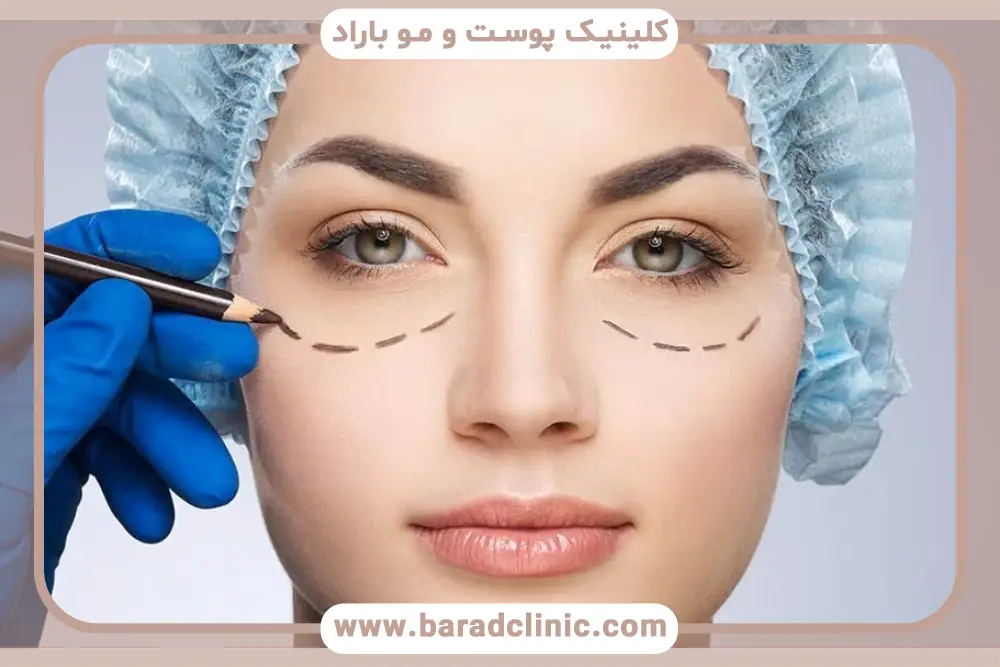 علت ایجاد خط بخیه بلفاروپلاستی