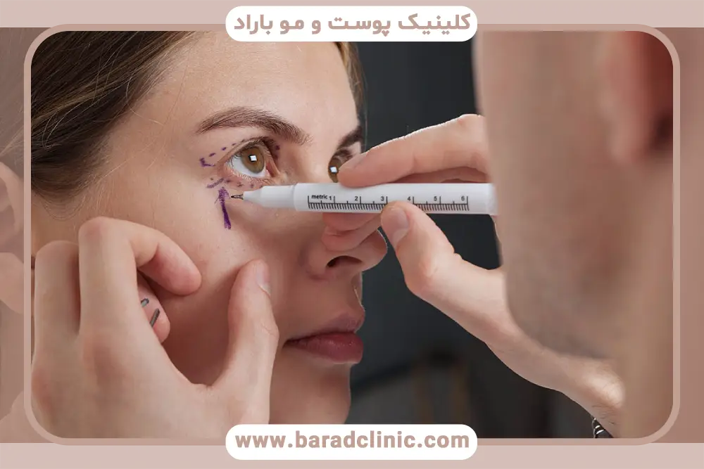 تجربه جراح بلفاروپلاستی در تهران