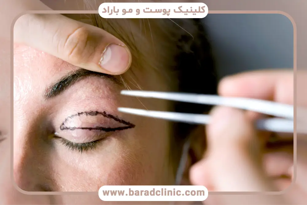 تفاوت بلفاروپلاستی درمانی و زیبایی