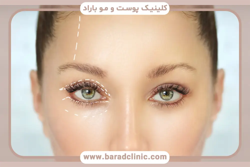 انواع بلفاروپلاستی سرپایی 