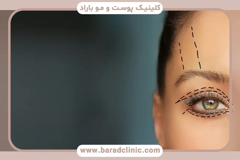 انواع روش بلفاروپلاستی