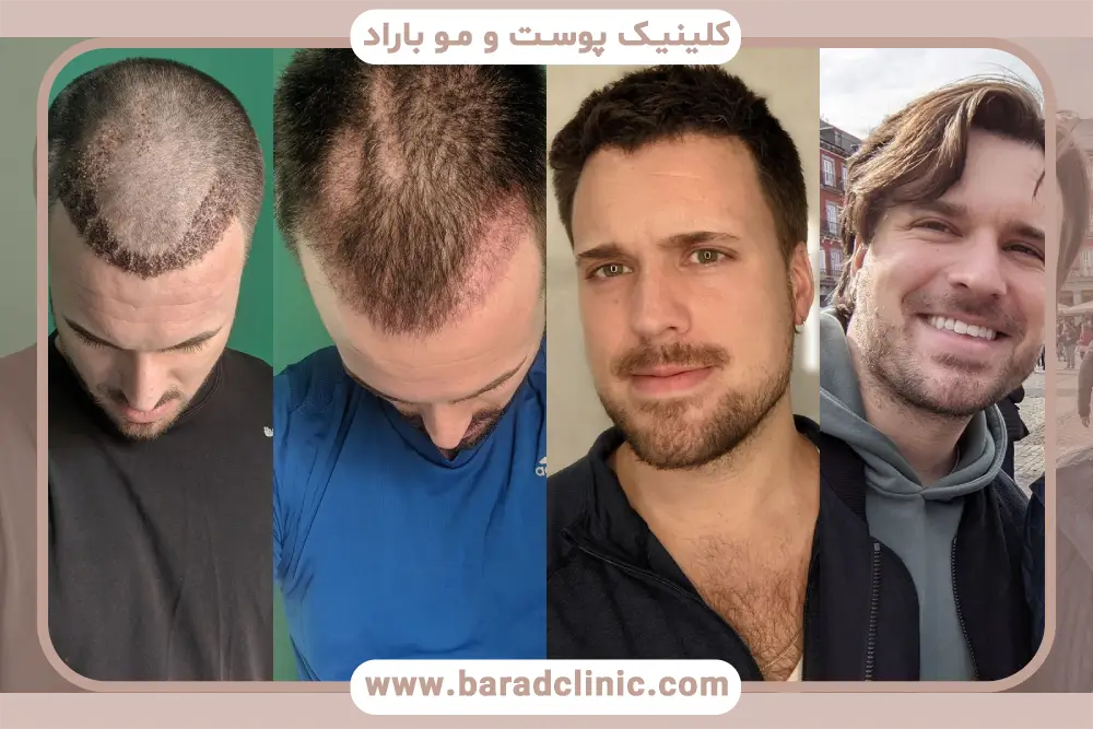 مزایای عکس کاشت مو