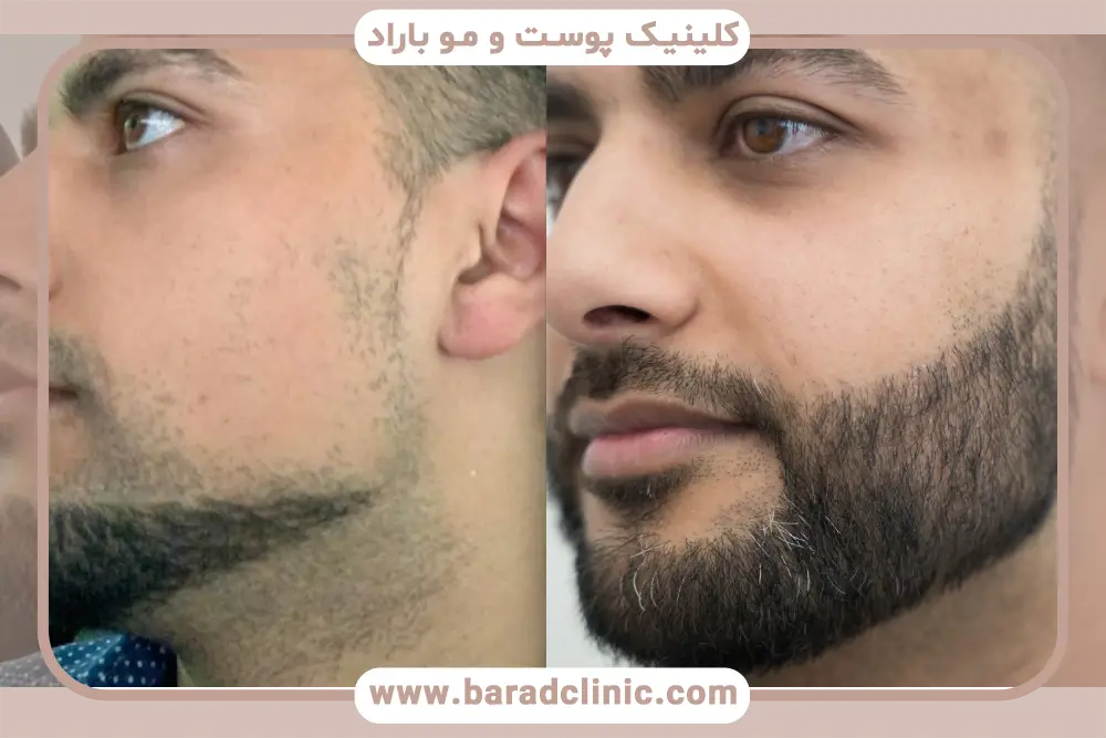 تصاویر قبل و بعد کاشت ریش با روش‌های مختلف 