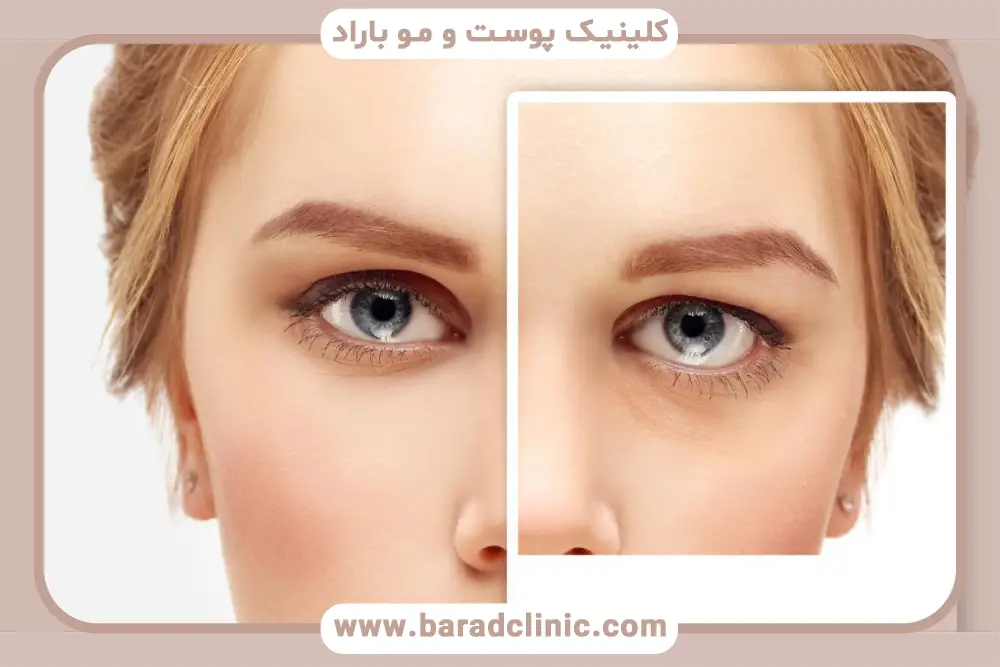 معرفی بلفاروپلاستی ابرو