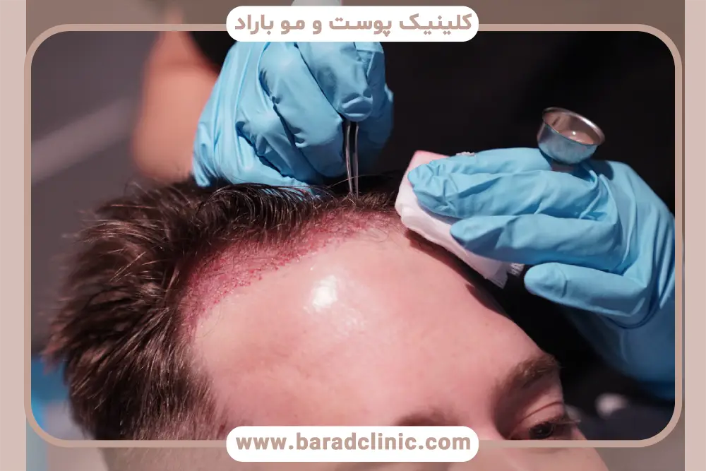 خدمات بهترین کاشت مو در تهران 