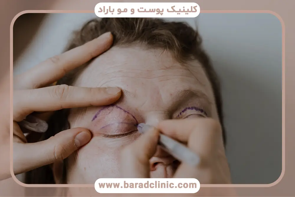 تفاوت بلفاروپلاستی با لیزر و جراحی سنتی