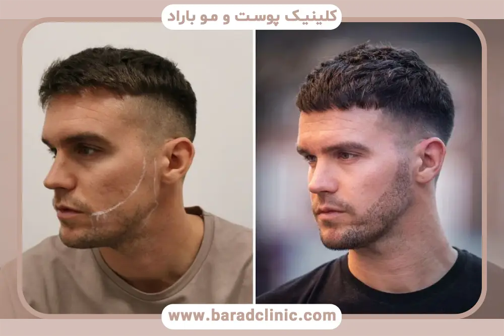 سلامت عمومی از مهم‌ترین شرایط کاشت ریش 