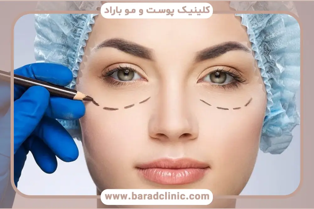 عوارض طبیعی بلفاروپلاستی