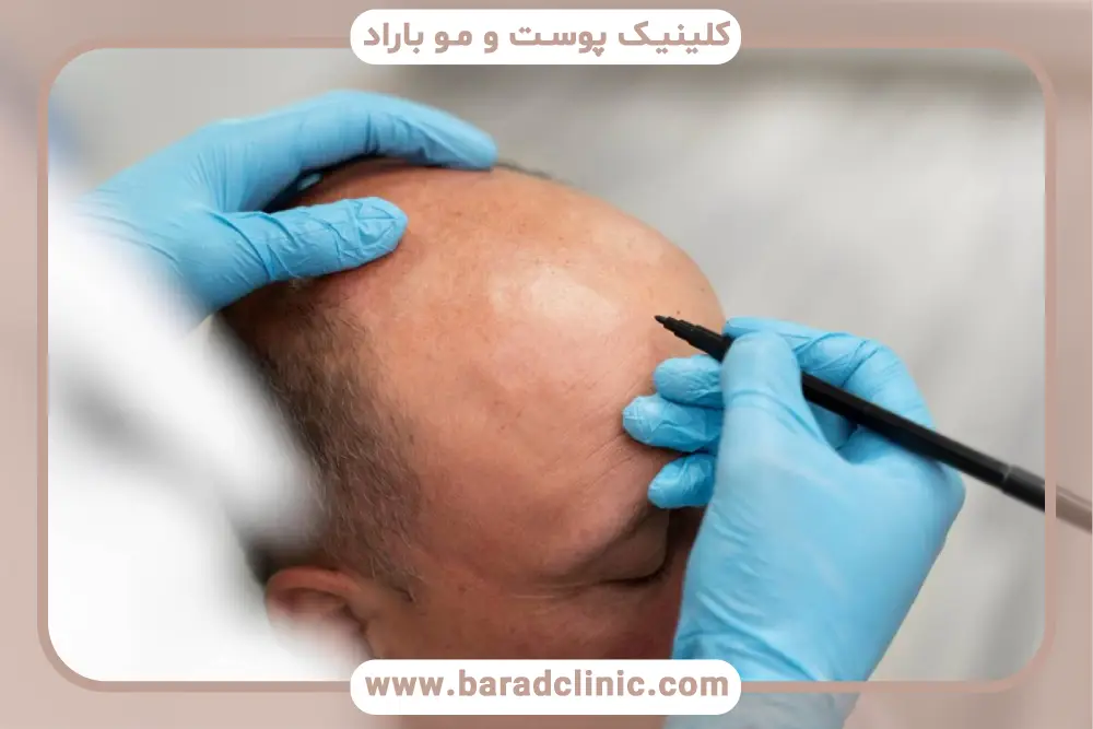 انتخاب بهترین روش کاشت در مشاوره کاشت مو تهران 