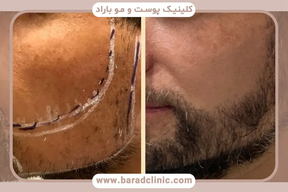 تفاوت کاشت ریش بدون جراحی با روش‌های سنتی