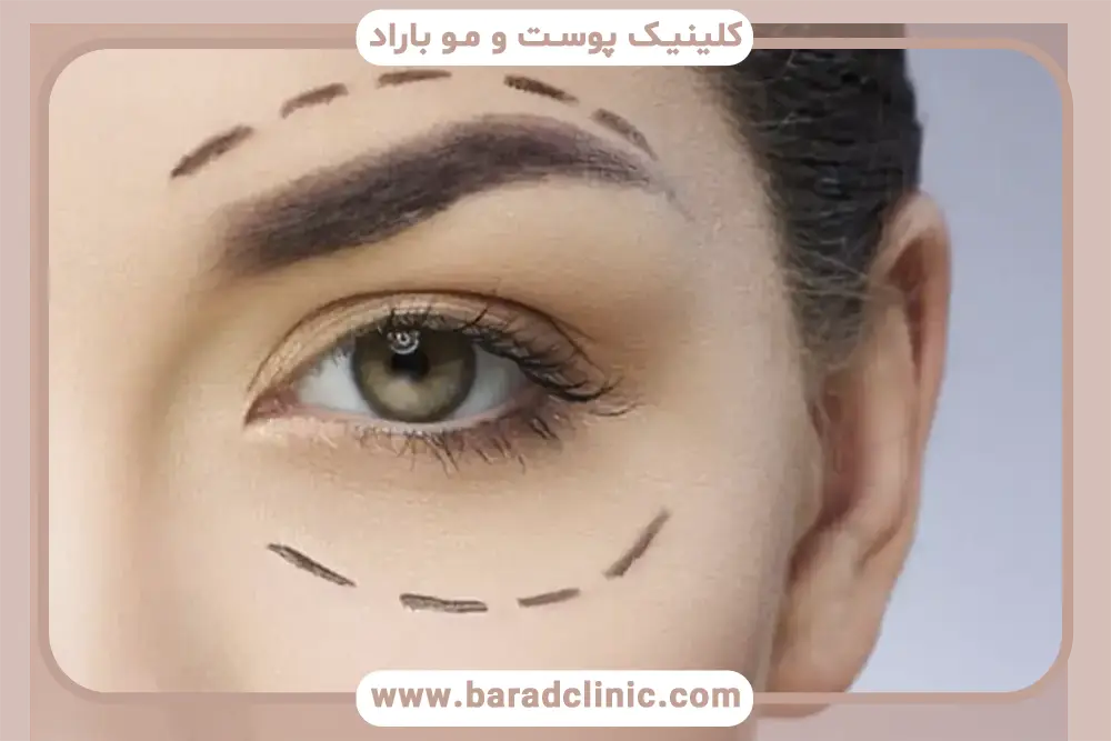 انتخاب از بین بلفاروپلاستی با بی حسی یا بیهوشی