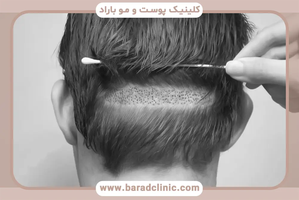 بررسی کلی هزینه کاشت مو fut